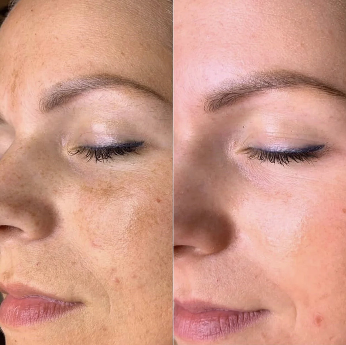 PDF - How to set up an anti acne routine
